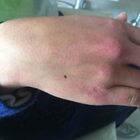 dermatitis-quantum-antes
