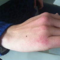quantum-derma-despues